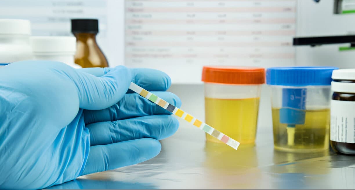 İdrarda Protein Kaçağı Nedir? Belirtileri Nelerdir?